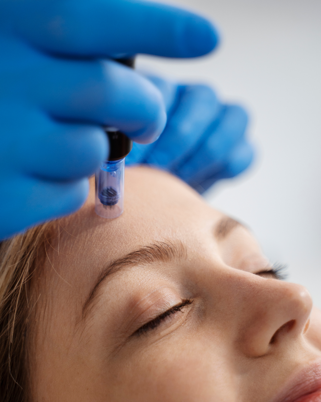 Modbod microneedling treatment